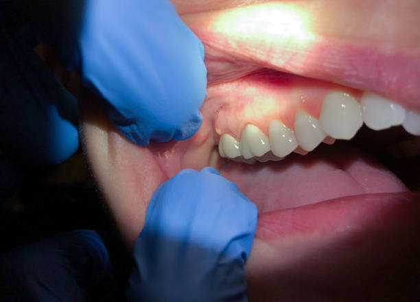 Best Emergency Dental Care for Broken or Chipped Teeth in Godfrey, IL